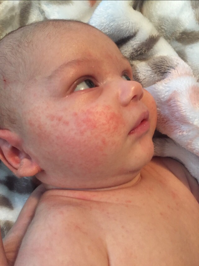 baby zits? heat rash? allergic reaction? Glow Community
