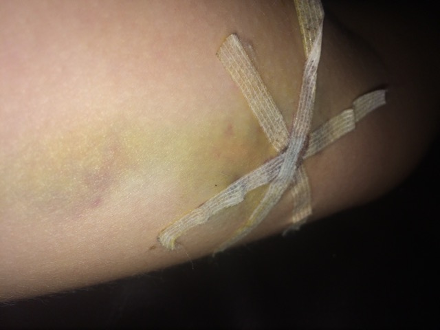 Nexplanon bruise - Glow Community