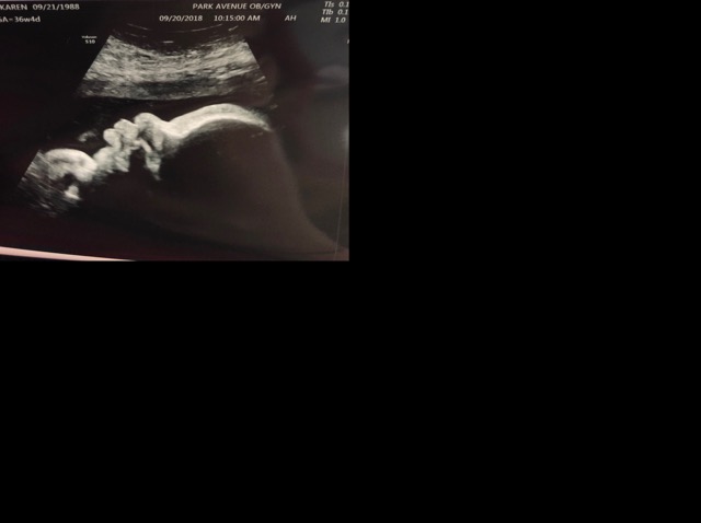 36 Week Ultrasound Nhs