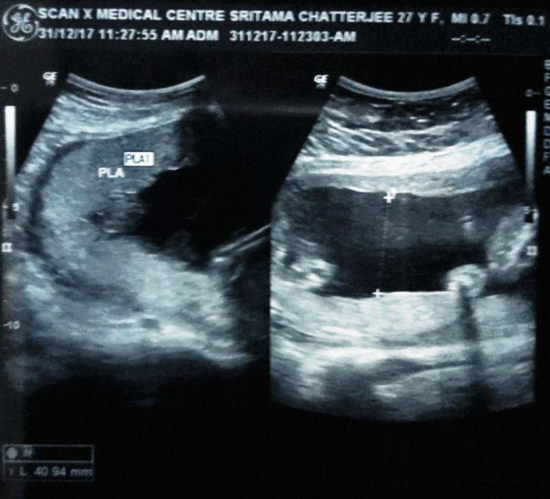 How To Tell Boy Ultrasound Pictures