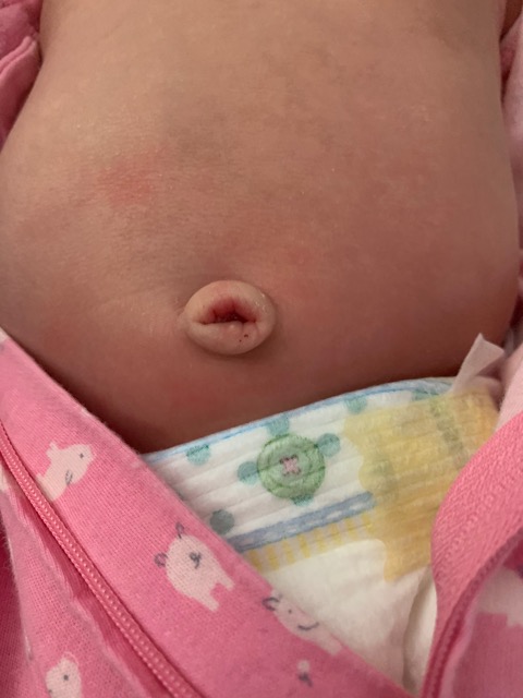 What Does An Outie Belly Button Look Like On A Newborn