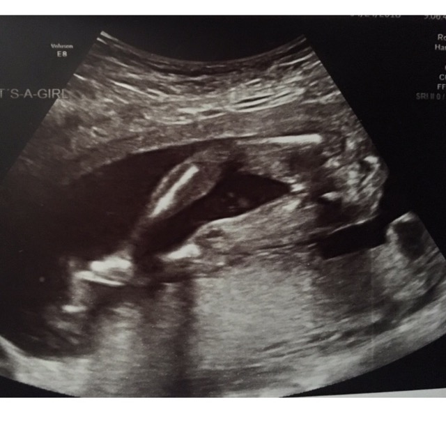 Baby Girl Sign In Ultrasound Report