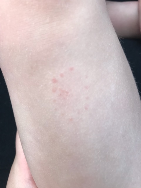 Round Rash On Leg