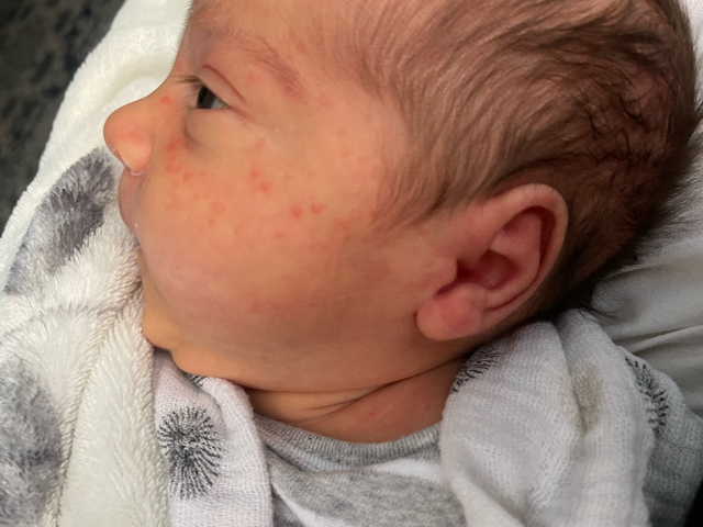 Bumpy Rash Baby Face Bumps/rash on baby’s face - Glow Community