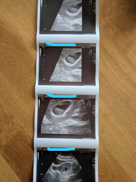 8 Weeks 4 Days Ultrasound - Glow Community