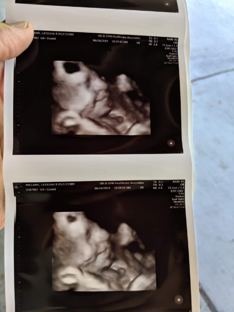 32 Weeks Pregnant Scan Pictures